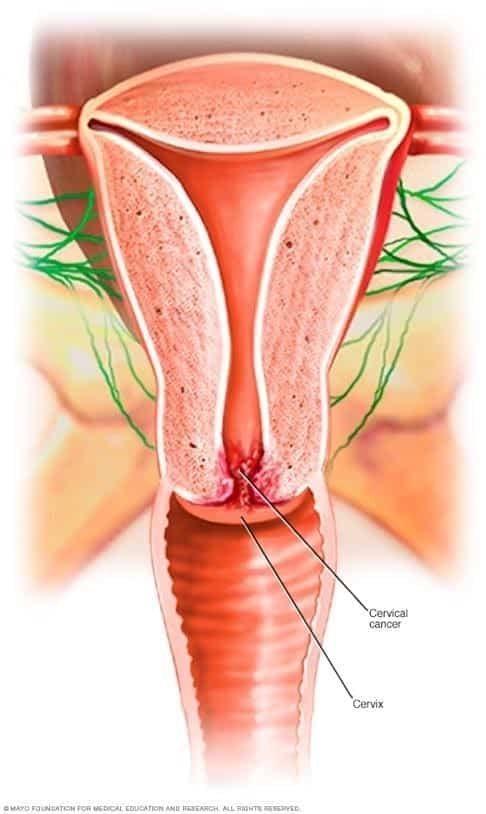 cervicalcancer imagery 1
